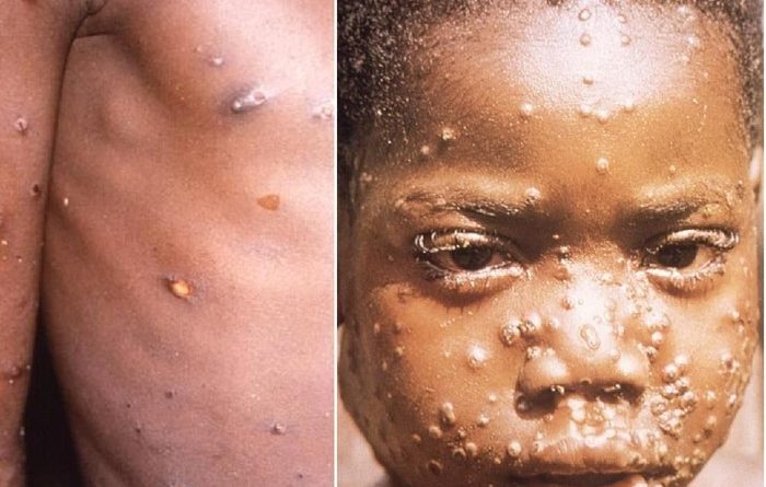 Cacar monyet menyebar di Eropa, Inggris tawarkan vaksin