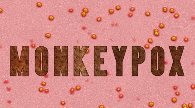 IDI Anjurkan ke Dokter Jika Alami Gejala Monkeypox