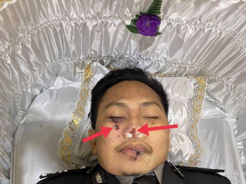 Kondisi Mayat Brigadir J