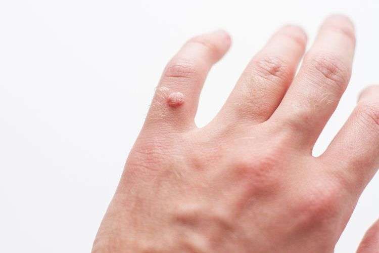 Pemerintah Perluas Sasaran Vaksin HPV pada Laki-laki