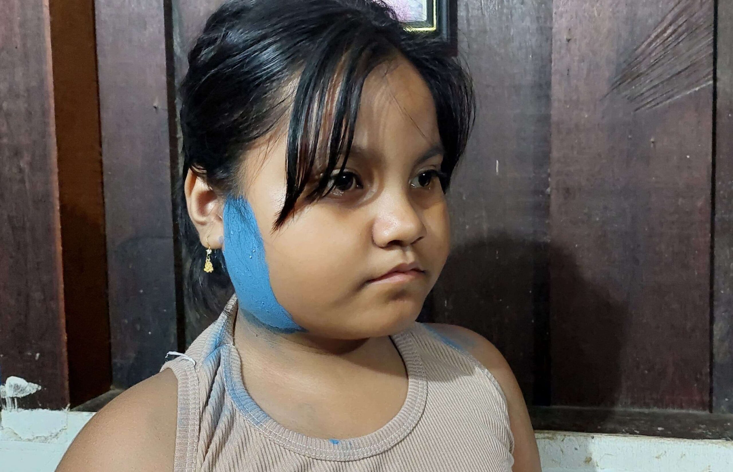 Dinas Kesehatan Benarkan Kasus Gondongan Marak Di Bekasi