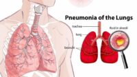Dokter: Kipas angin dan mandi malam tak sebabkan pneumonia