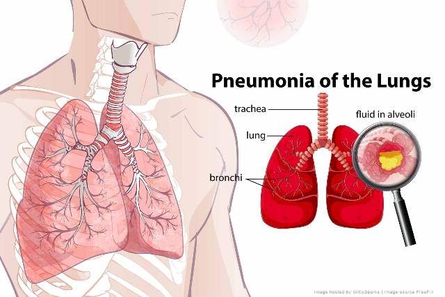 Dokter: Kipas angin dan mandi malam tak sebabkan pneumonia