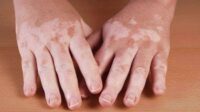 2r9niqwcf24mmyy Menkes: Vitiligo Bukan Penyakit Memalukan